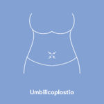 Umbilicoplastia Cirug A De Abdomen Dr Jos Cort S