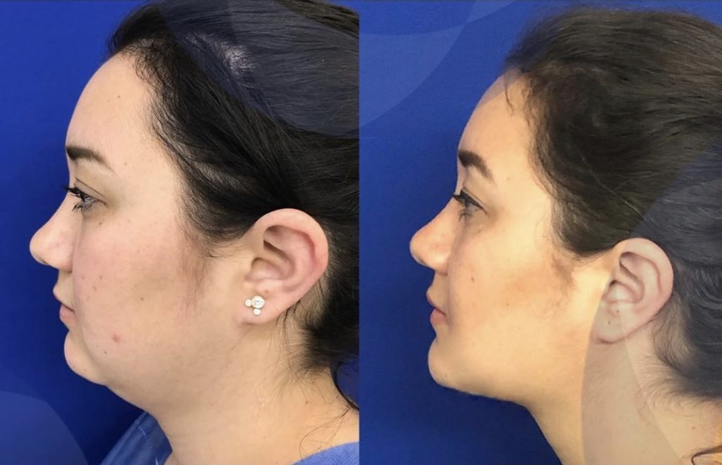 Lifting Facial Sin Cirugia