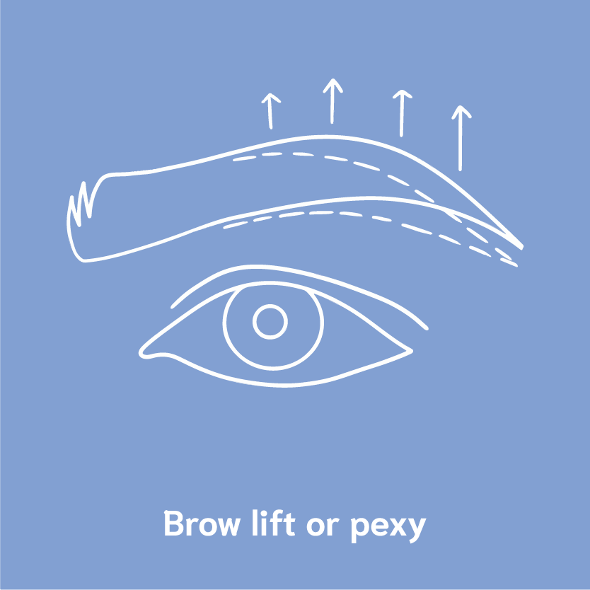 brow lift or pexy