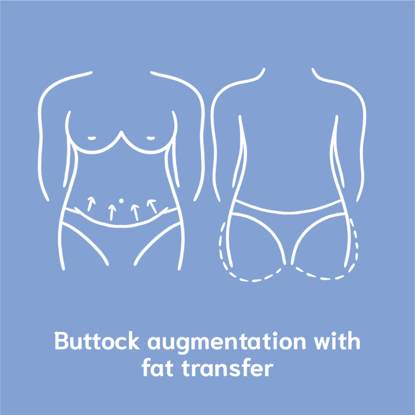 buttock augmentatioin with fat transfer