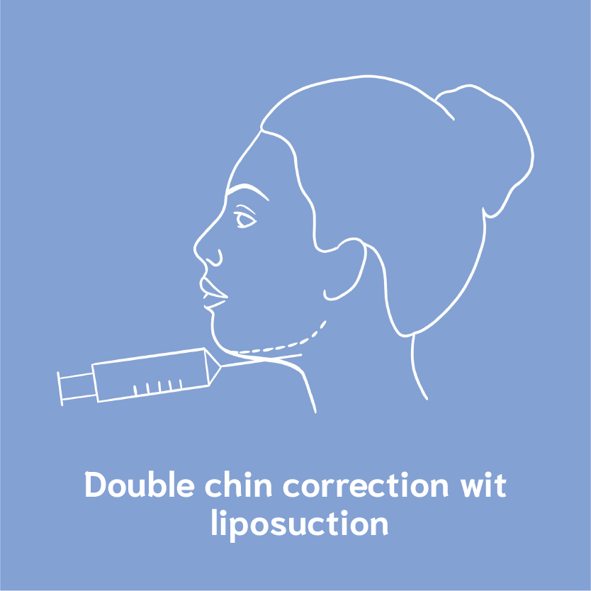 double chin correction with liposuctionn