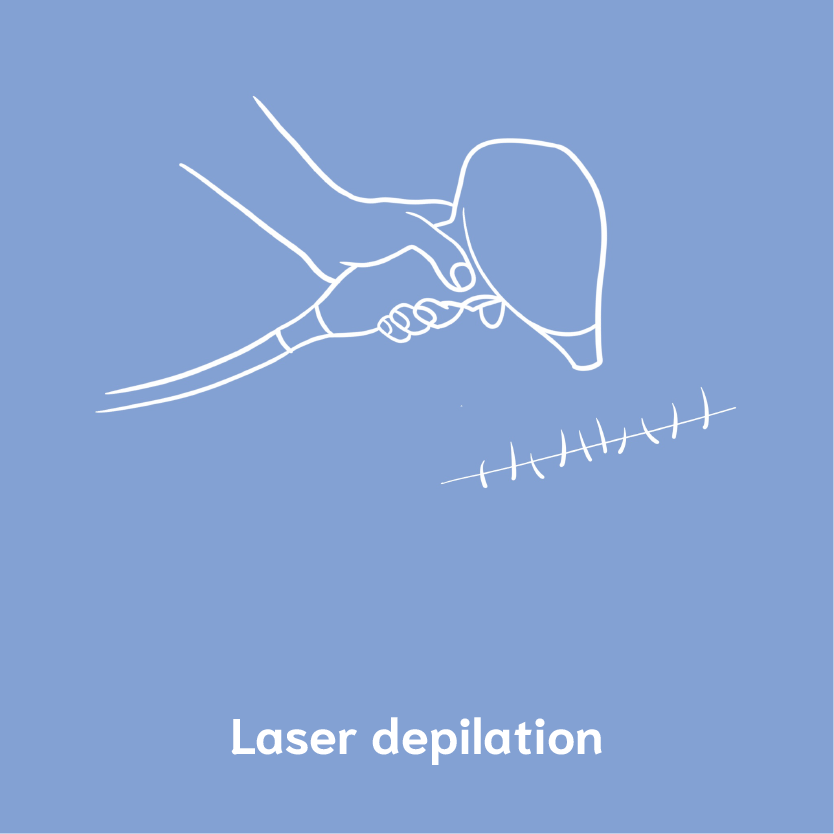 laser depilation