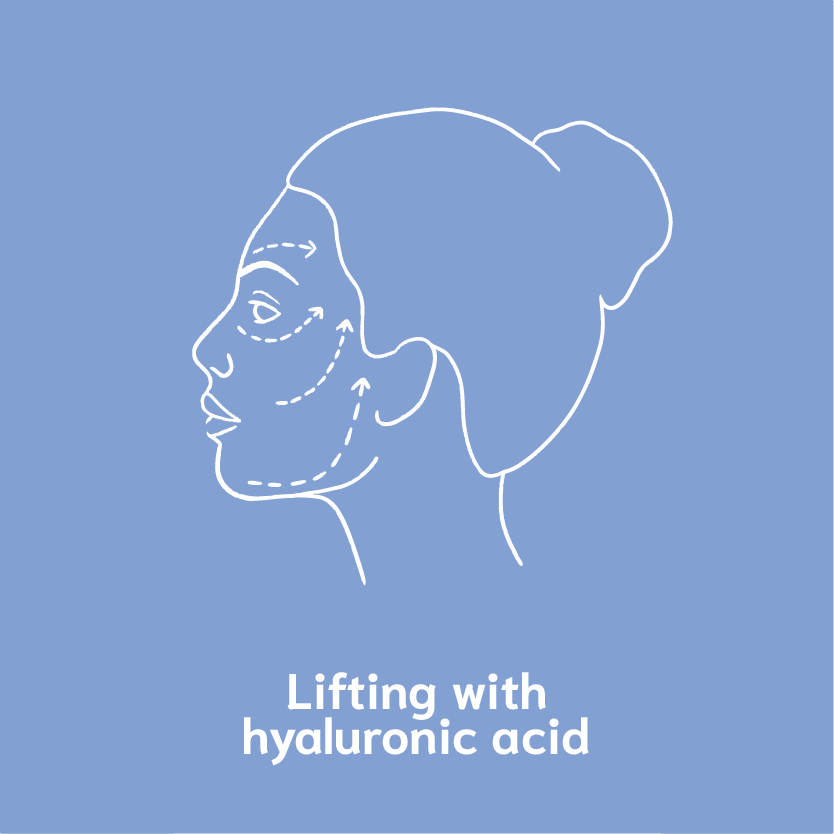 lifting with hyaluronic acid
