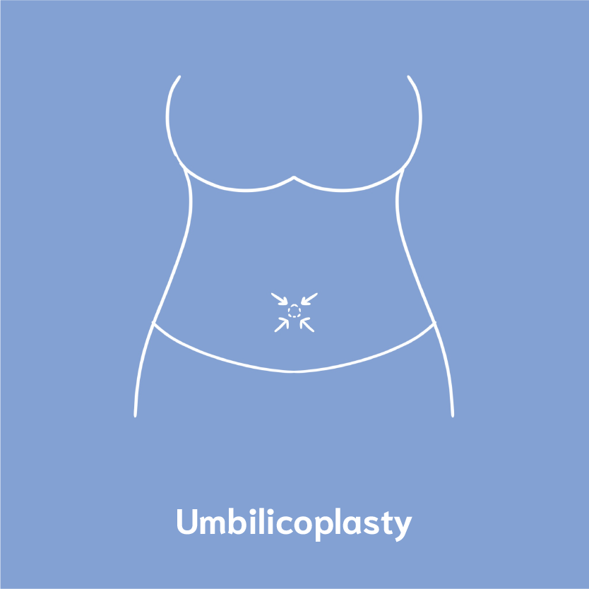 umbilicoplasty
