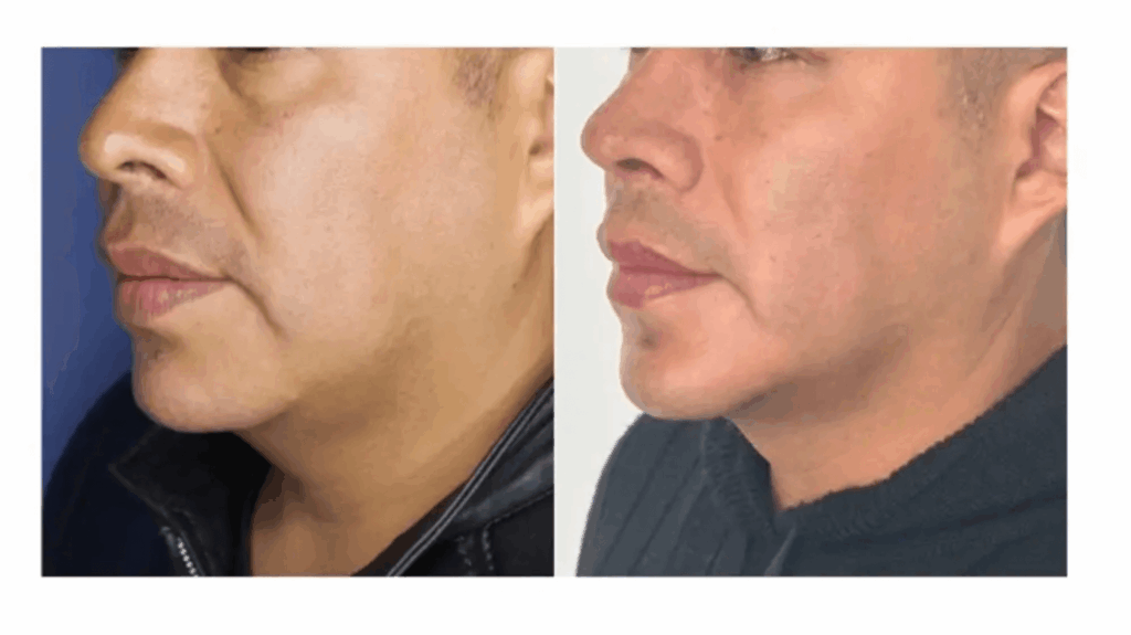 endolift facial and body