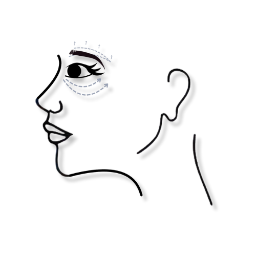 levantamiento con acido hialuronico cejas.png