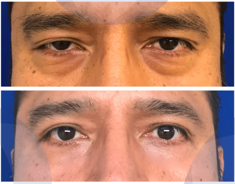 Blefaroplastia Superior E Inferior