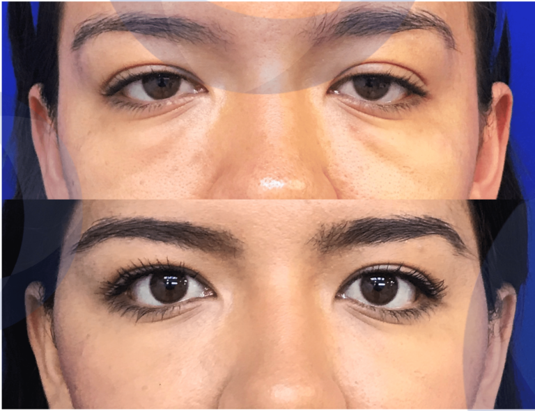 Correccion Ojeras Acido Hialuronico