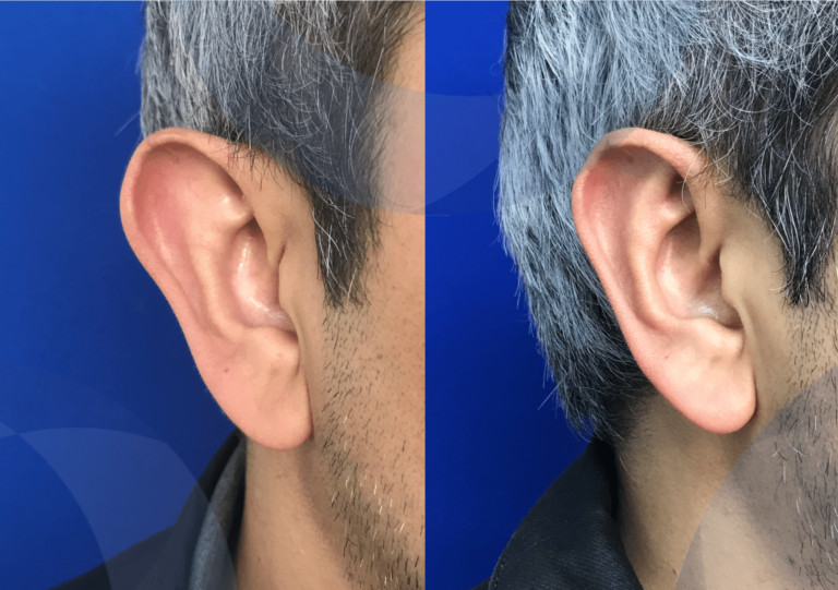 Otoplastia Cirugia