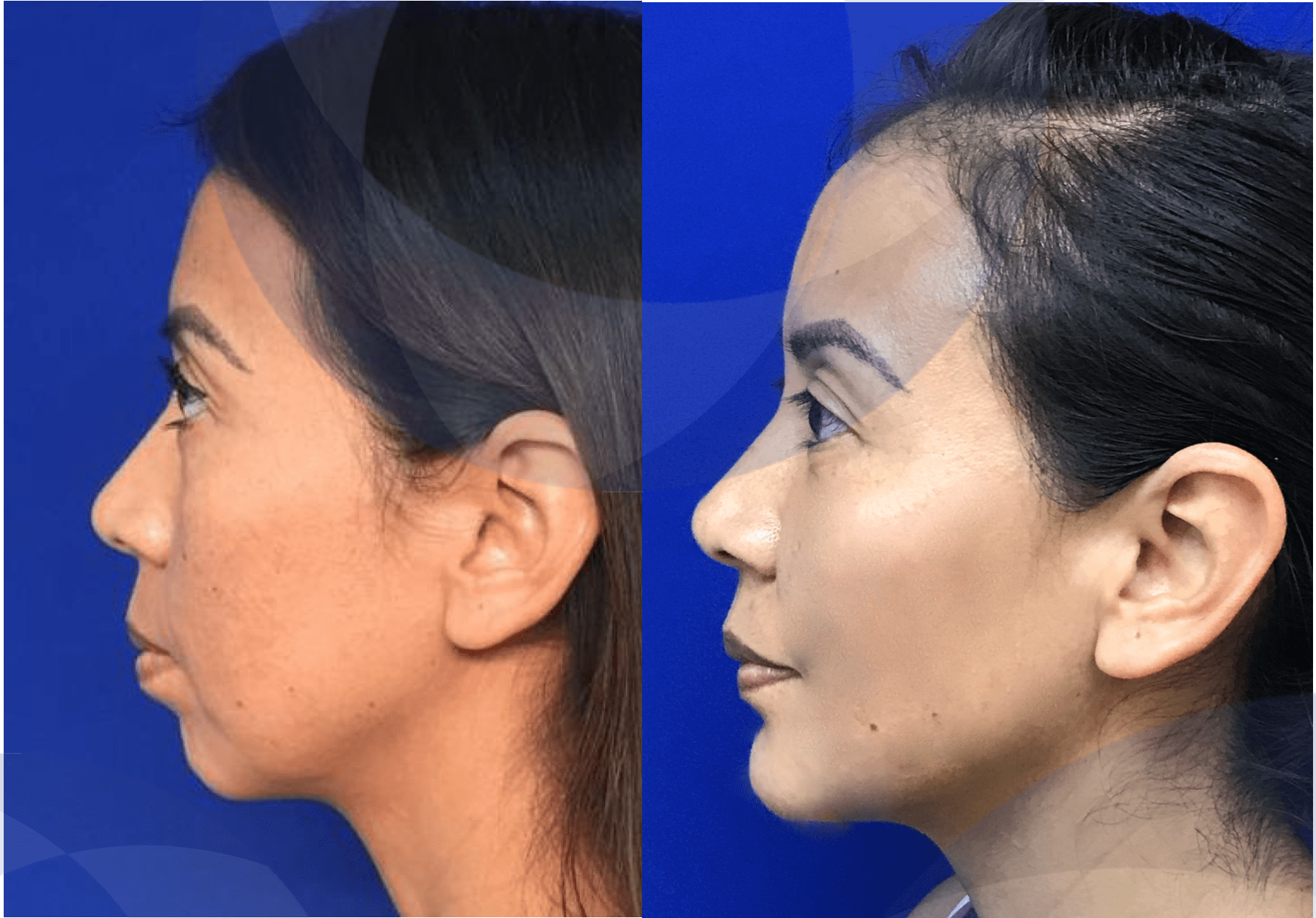 Perfilamiento y armonización facial José Cortés Institute
