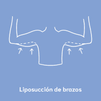 Liposuccion De Brazos