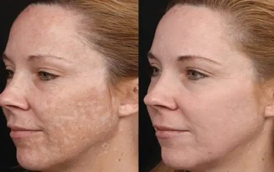 peeling facial con láser resultados