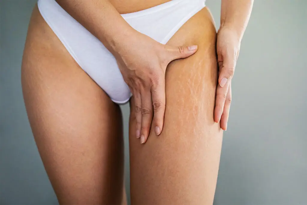 peeling químico para eliminar estrías