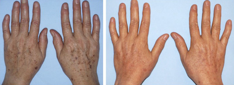 laser para eliminar las manchas en las manos y rejuvenecerlas