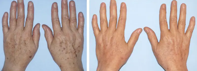 laser para eliminar las manchas en las manos y rejuvenecerlas