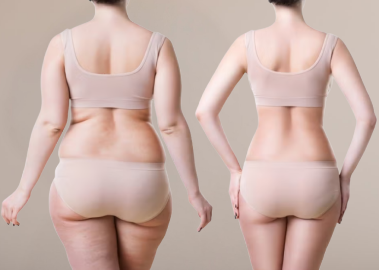 lipoescultura