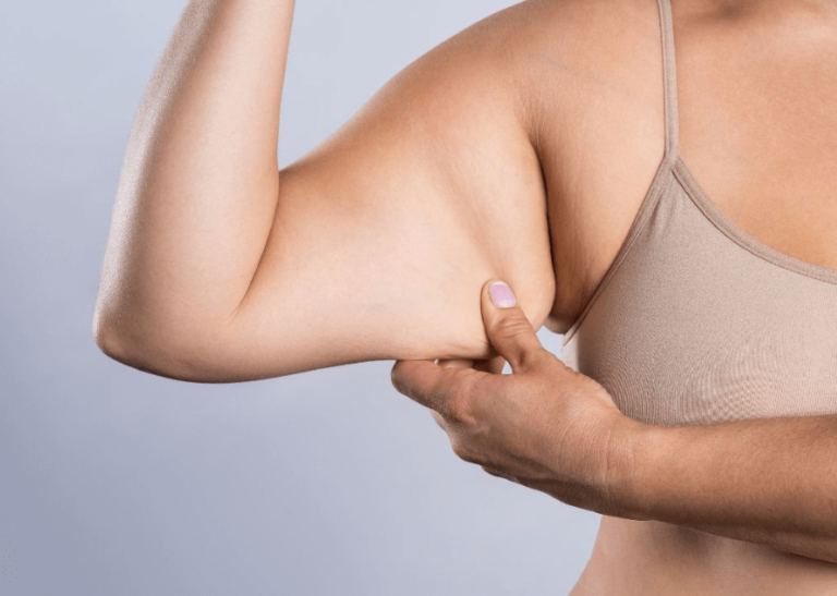liposuccion de brazo