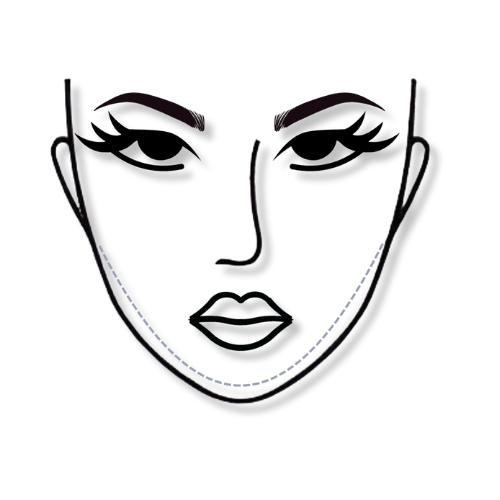 mentoplastia