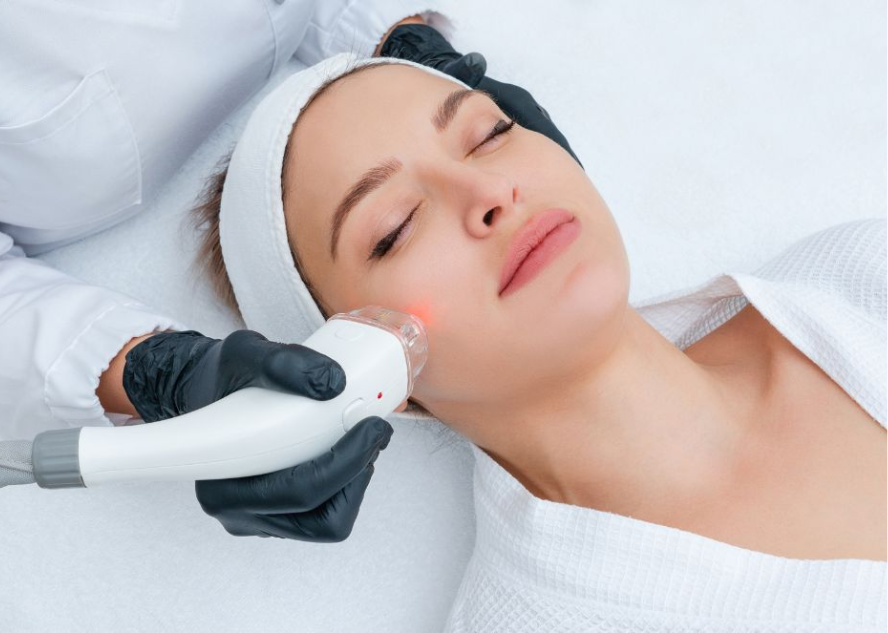 peeling facial con laser tratamiento