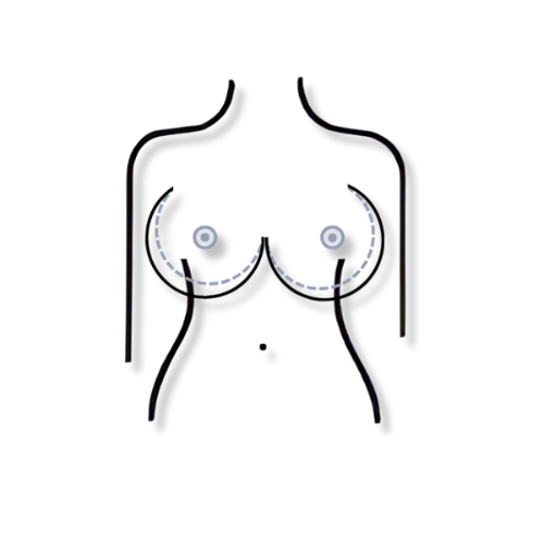 mamoplastia de reduccion